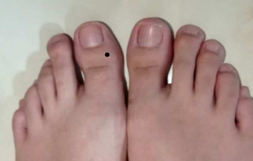 Nốt ruồi ở ngón chân cái tốt hay xấu? Nốt ruồi dưới, đầu ngón chân cái ý nghĩa gì?